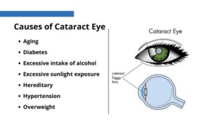 Causes of Cataracts