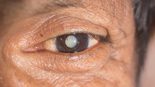 Cataract cost india